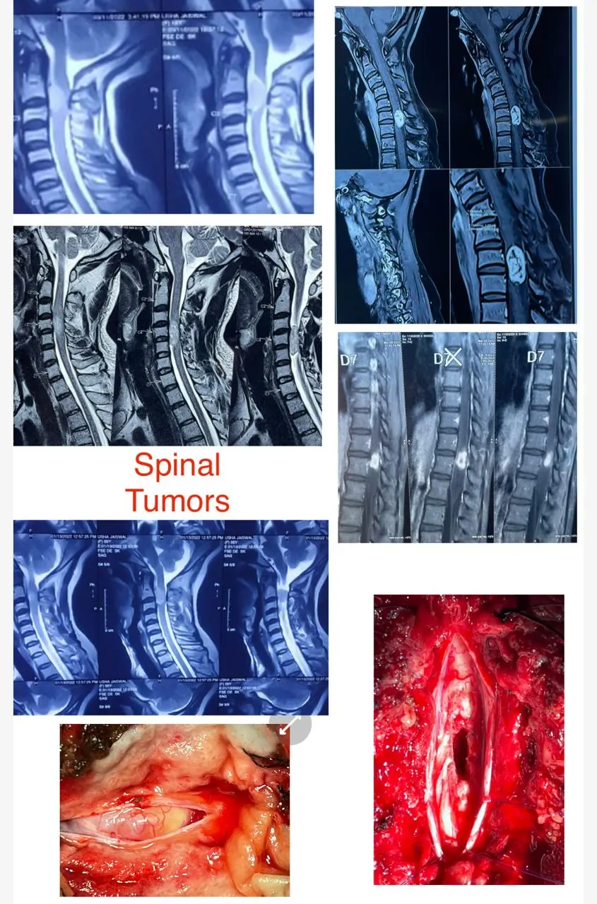 Dr. Abhishek Songara Instagram — Angel Brain & Spine Clinic, Indore